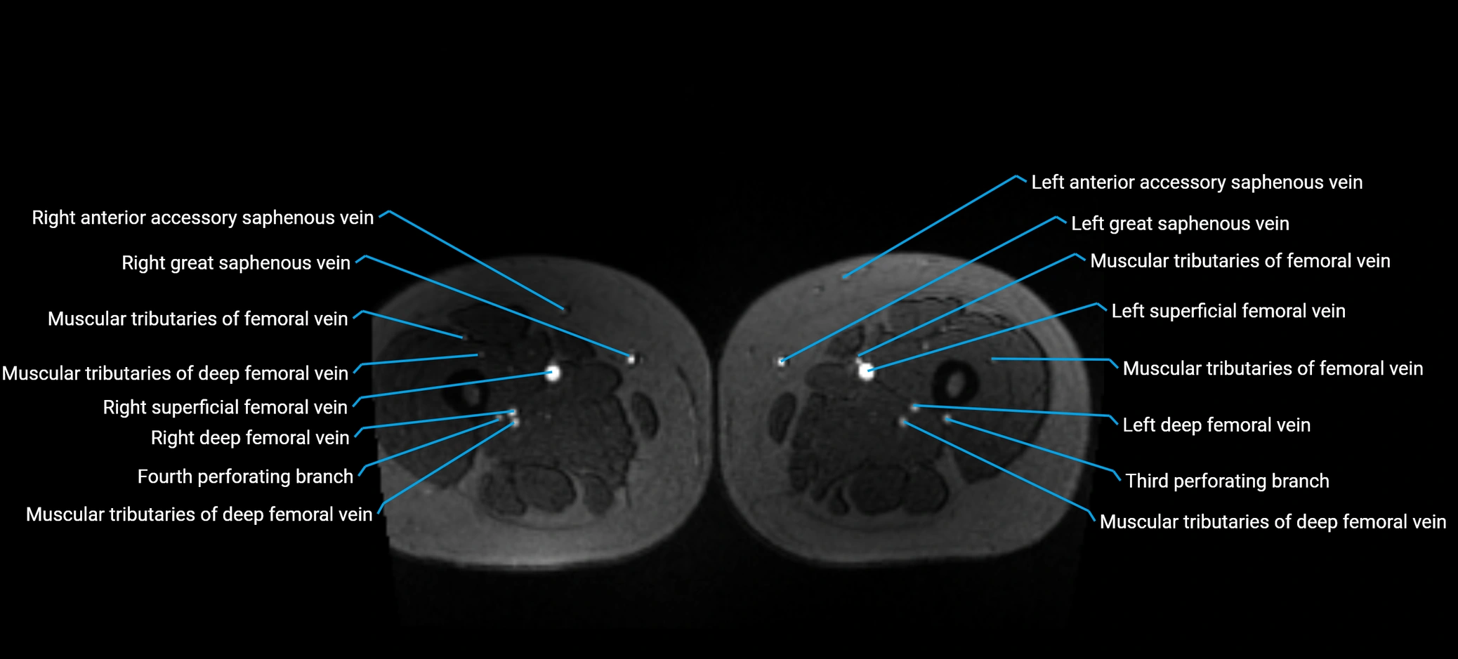 MRV abdomen pelvis & lower limb axial cross sectional anatomy labelled MRI image 256 (1).webp